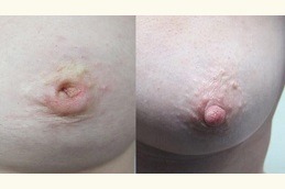Inverted Nipple Surgery Clinic in Dubai