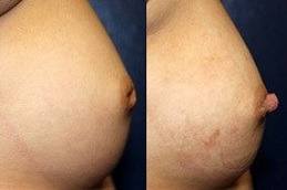 Inverted Nipple Surgery in Abu Dhabi