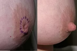 Inverted Nipple Surgery in Dubai & Abu Dhabi