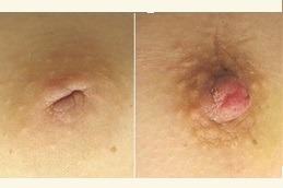 Inverted Nipple Surgery in Dubai