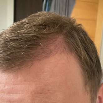 Is Dubai a Good Place for Hair Transplants?