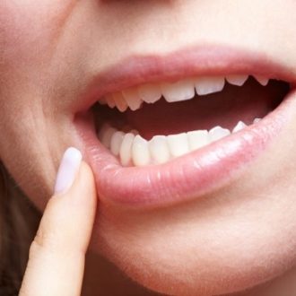 Root Canal Treatment for Chipped Tooth in Dubai