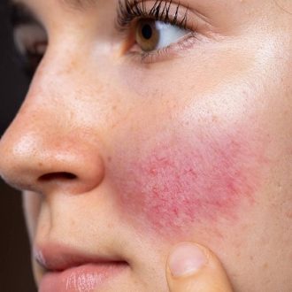Rosacea Treatment For Women in Dubai