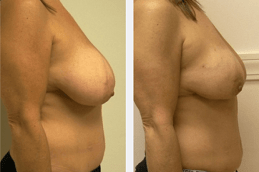 Scarless Breast Augmentation Dubai