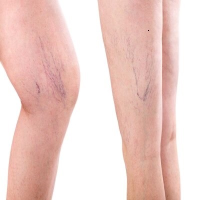 How to Get Rid of Spider Veins on Legs