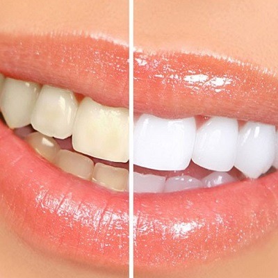 Teeth Cleaning and Whitening Treatment in Dubai