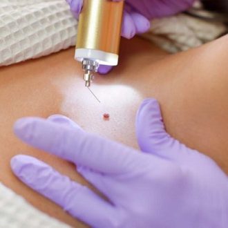 Warts Removal Surgery Pros and Cons