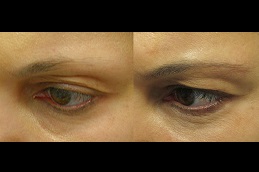 eyelash-hair-transplant-cost-Clinic-in-Dubai