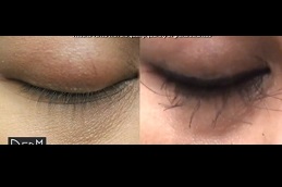eyelash-hair-transplant-cost in Abu Dhabi