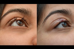 eyelash-hair-transplant-cost in dubai