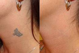 how-long-after-laser-tattoo-removal-can-i-get-a-cover-up in Abu Dhabi