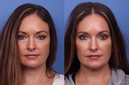 Best Clinic of Can Eye Bags Return After Blepharoplasty in Dubai - Copy