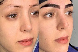 Best Clinic of Eyebrow Transplant for Thick Brows Dubai