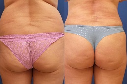 Best Clinic of French Butt Reshaping in Dubai