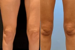 Best Clinic of J Plasma for Thighs and Arms Dubai