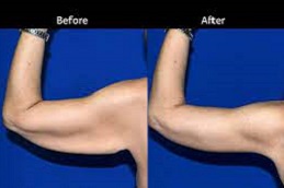 Best Clinic of J Plasma for Thighs and Arms in Dubai