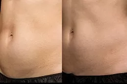 Best Clinic of Non-Invasive Fat Removal Dubai