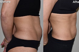 Best Clinic of Non-Invasive Fat Removal in Dubai