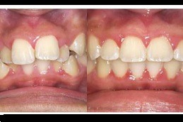 Best Clinic of Overlapping Teeth Treatment Cost in Dubai - Copy
