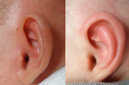 Best Clinic of Preauricular Tag Removal in Dubai