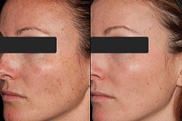 Best Clinic of Salicylic Acid Peeling Dubai