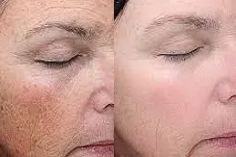 Best Clinic of Salicylic Acid Peeling in Dubai