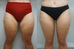 Best Clinic of Thigh Lift Cost in Dubai UAE