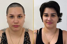 Best Eyebrow Transplant for Thick Brows in Dubai