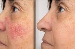Best Facial Capillaries Treatment in Dubai