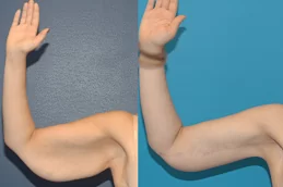 Best J Plasma for Thighs and Arms Dubai