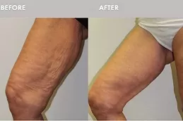 Best J Plasma for Thighs and Arms in Dubai