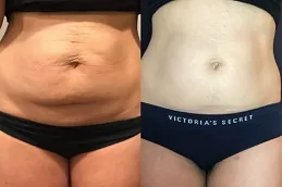 Best Non-Invasive Fat Removal Dubai