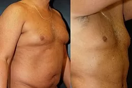 Best Non-Invasive Fat Removal in Dubai