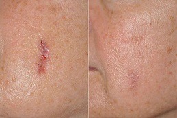 Best Post Surgical Scar Removal Cost Dubai & Abu Dhabi - Copy