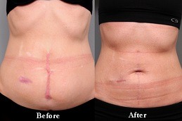 Best Post Surgical Scar Removal Cost in Dubai & Abu Dhabi
