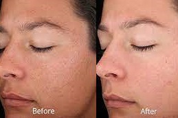 Best Salicylic Acid Peeling Dubai