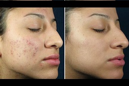 Best Salicylic Acid Peeling in Dubai