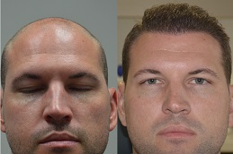 Best hair-transplant-charges in Abu Dhabi