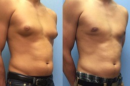 Can You Get best Gynecomastia Treatment Without Surgery in Dubai