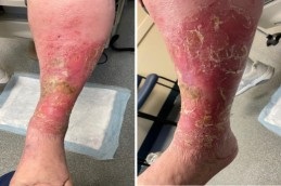 Chronic Wounds Clinic Dubai