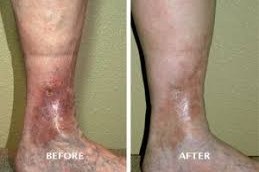 Chronic Wounds Clinic in Dubai