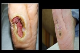Chronic Wounds Treatment Dubai