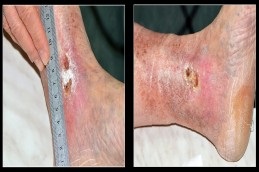 Chronic Wounds Treatment in Dubai
