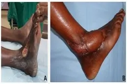 Chronic Wounds in Dubaiu