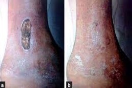 Chronic wounds in Dubai