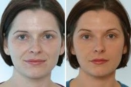 Cosmetic Injectables Dubai