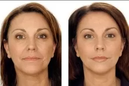 Cosmetic Injectables Treatment in Dubai