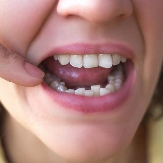 Crowded Teeth Treatment Cost in Dubai