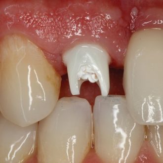 Dental Bonding Cementing Cost in Dubai