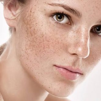 Freckles and Blemishes Treatment Cost in Dubai